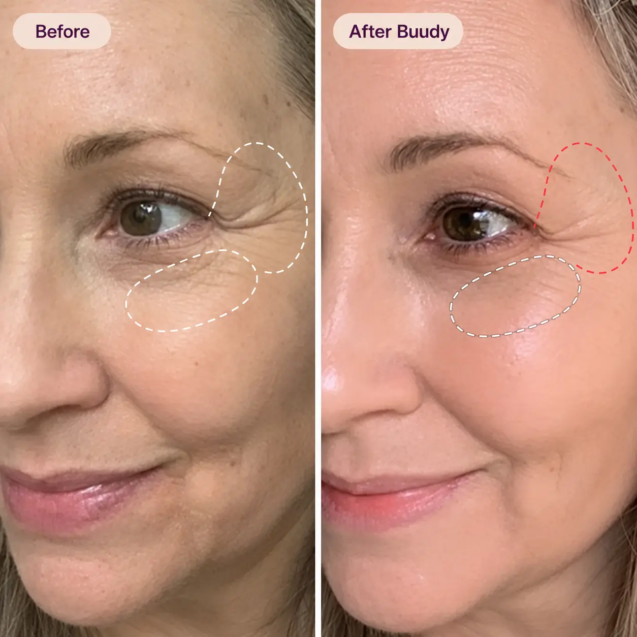 Buudy 7 Colour LED Mask before and after anti-ageing results: visibly reduces crow's feet and eye-area fine lines UK