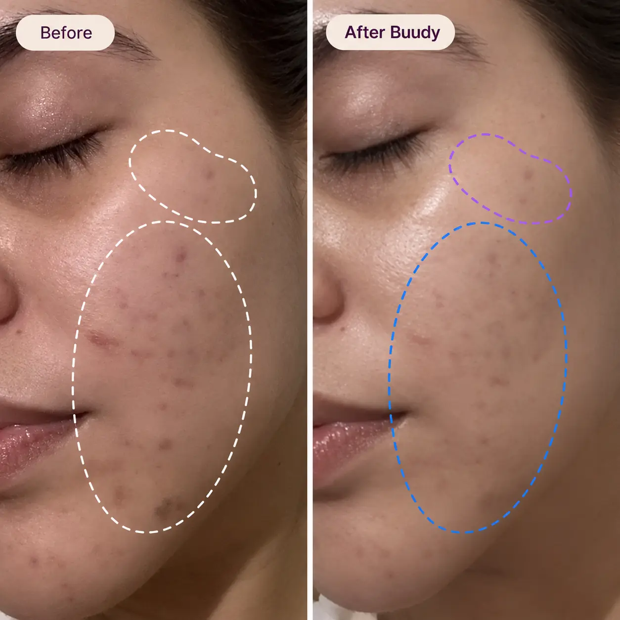 Buudy 7 Colour LED Face Mask before and after transformation: clears post-acne marks and enhances skin radiance UK