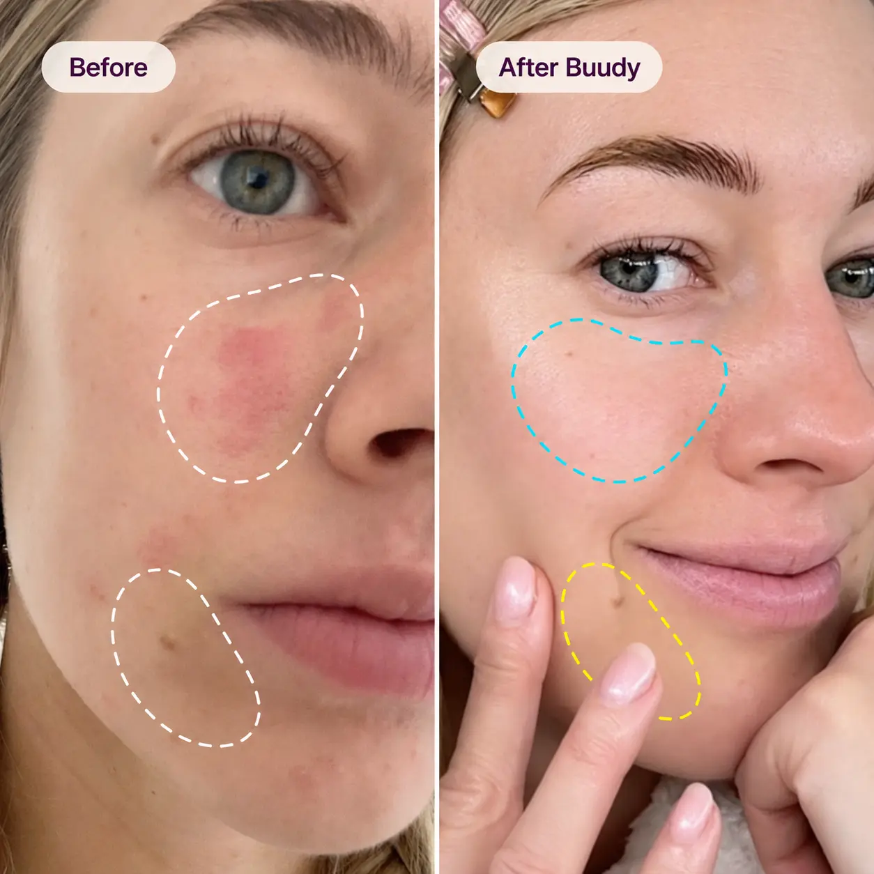 Buudy 7 Colour LED Face Mask before and after: calms facial redness, sensitivity and rosacea flush UK