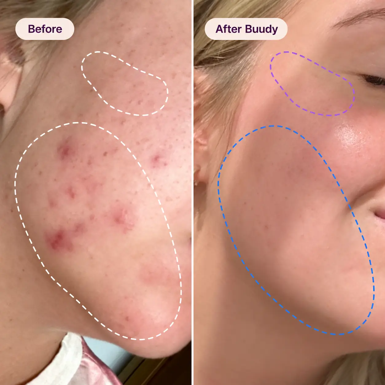 Buudy 7 Colour LED Mask before and after results: eliminates persistent cystic acne and smooths lower cheek and jawline UK