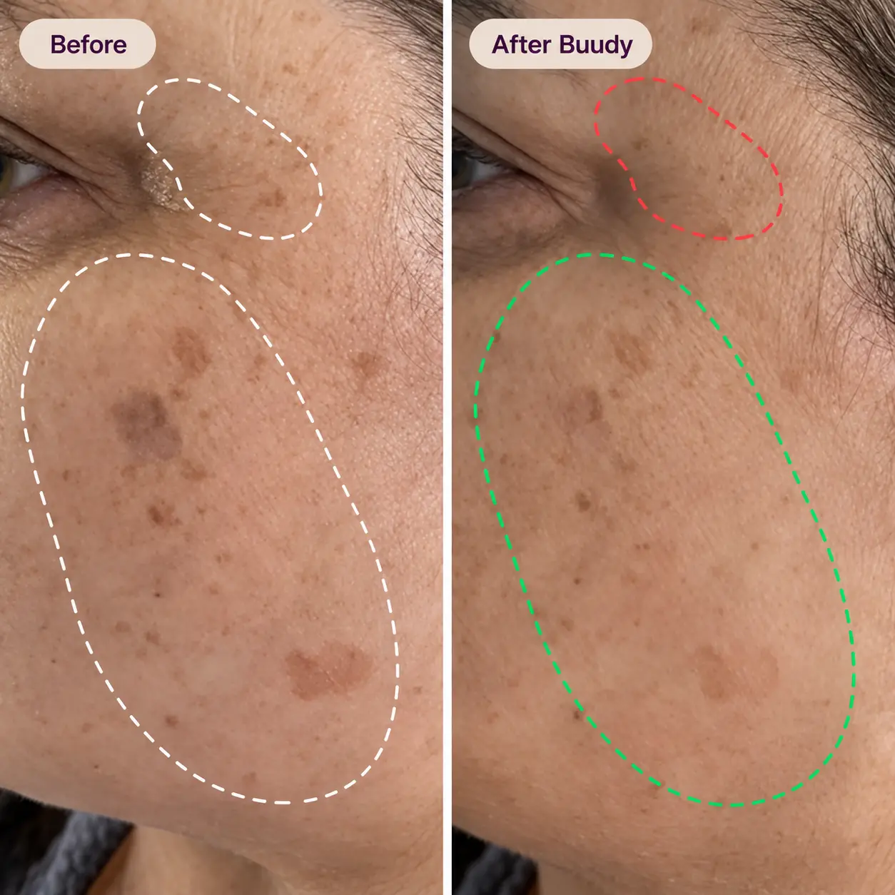 Buudy 7 Colour LED Face Mask before and after results: fades dark spots and sun-induced hyperpigmentation UK