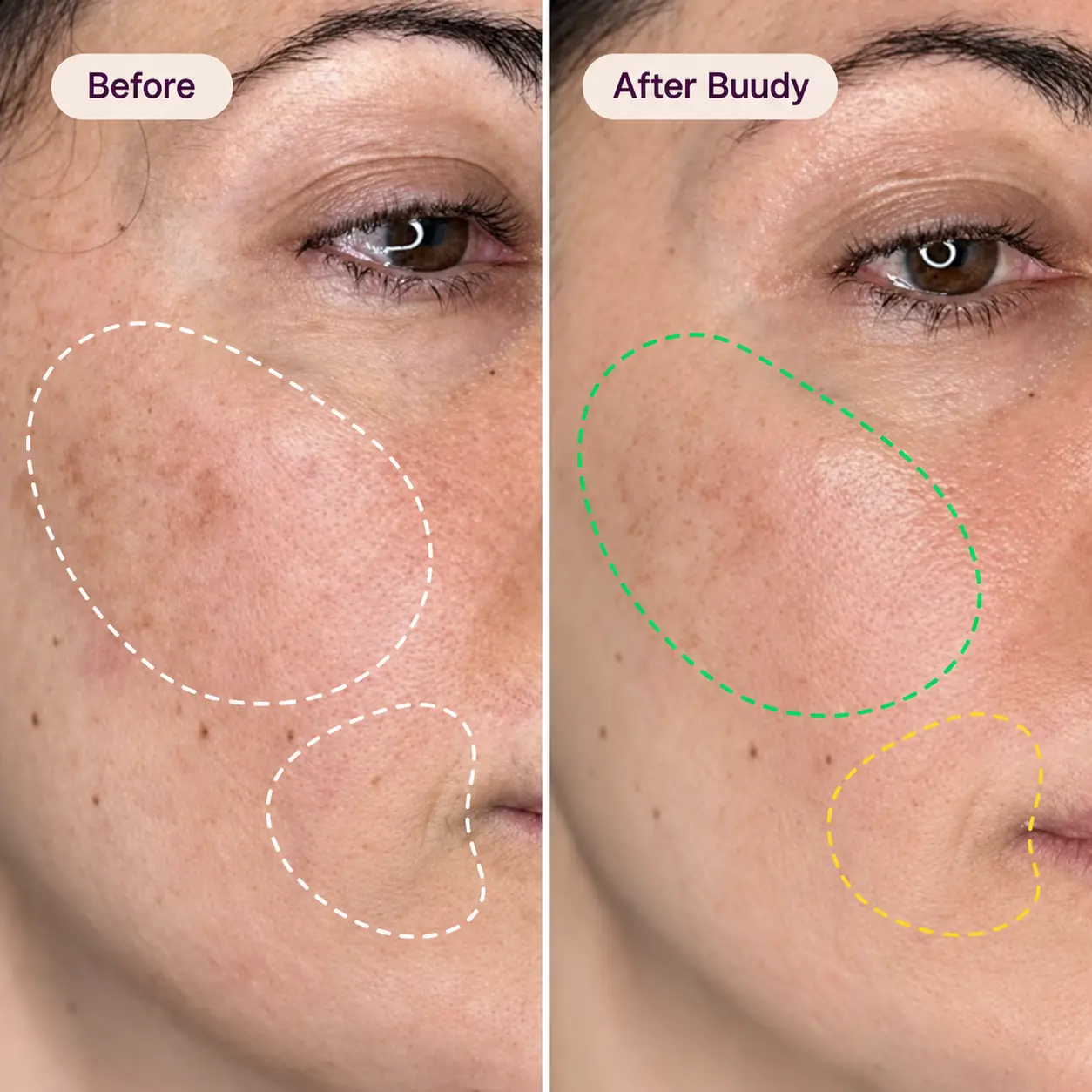 Buudy 7 Colour LED Mask before and after clinical comparison: evens mottled skin tone and smooths fine texture UK